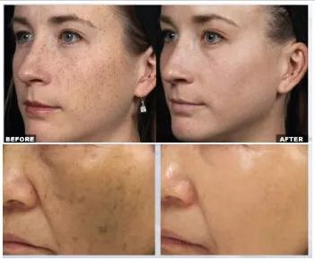 5个祛斑小妙招淡化晒斑雀斑痘印,痘印晒斑和疤痕用什么产品比较好