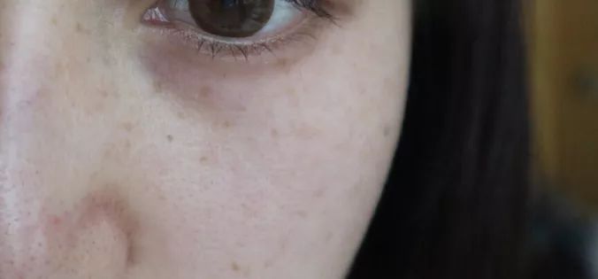 5个祛斑小妙招淡化晒斑雀斑痘印,痘印晒斑和疤痕用什么产品比较好