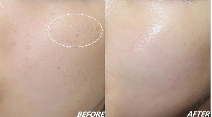 5个祛斑小妙招淡化晒斑雀斑痘印,痘印晒斑和疤痕用什么产品比较好