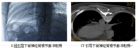 蛇盘疮带状疱疹可以吃病毒灵吗 (蛇缠头带状疱疹)