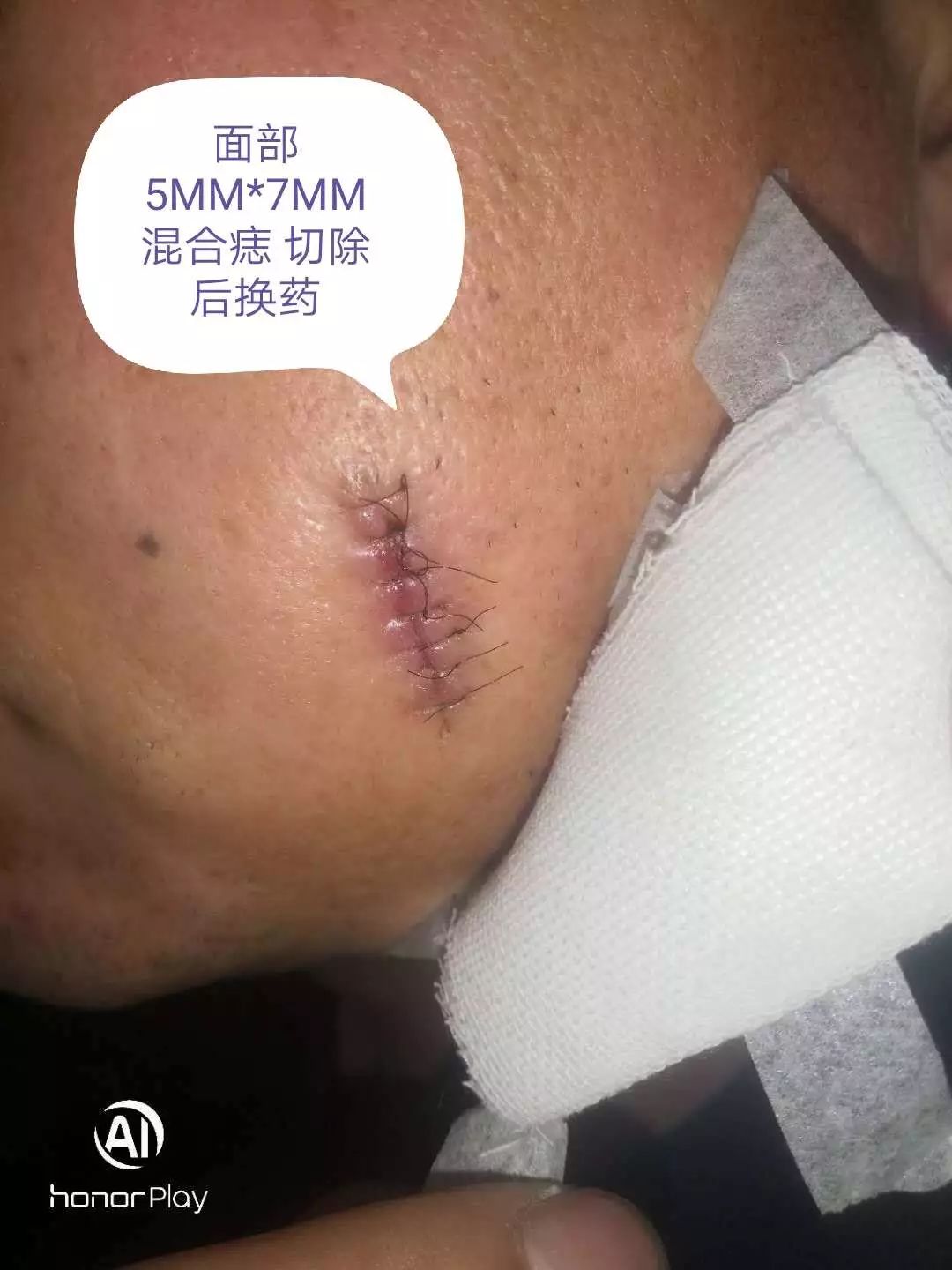 小小黑痣该不该治？该如何治？