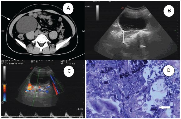 罕见的寄生虫病,常见寄生虫