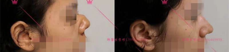 长鼻子如何通过整容改善,鼻子到底应该怎么修