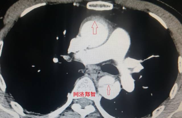 主动脉夹层cta能扫描出来吗,急性主动脉夹层cta影像诊断与鉴别