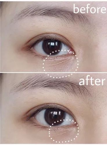 25岁必须用眼霜了吗,25岁之后适合用什么眼霜