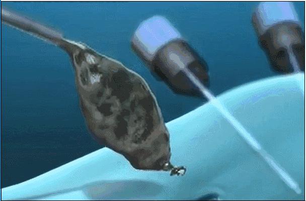 胆疼是什么感觉,胆很痛的时候怎么办