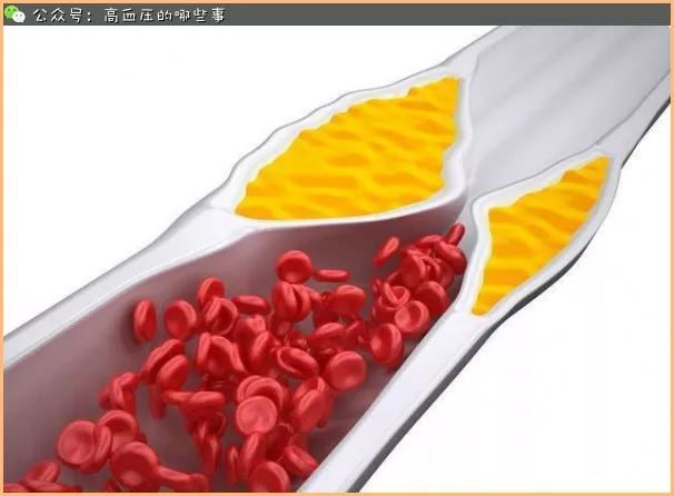血液高度粘稠导致血管堵塞怎么办,血管堵血液粘稠怎样调理