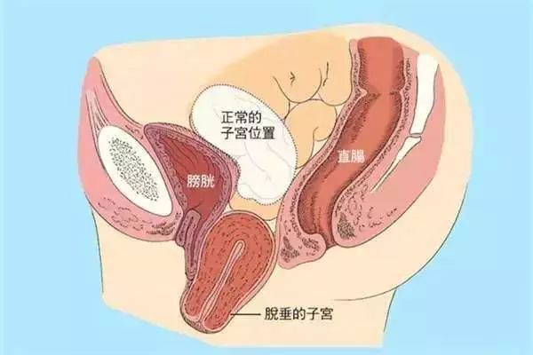 吓哭！她正跳着广场舞，肚子里竟然掉出了一样“东西”~~~
