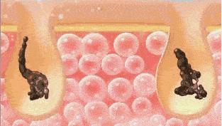 如何摆脱黑头反复的困扰才最有效,用黑头仪吸完黑头黑头还会再长吗