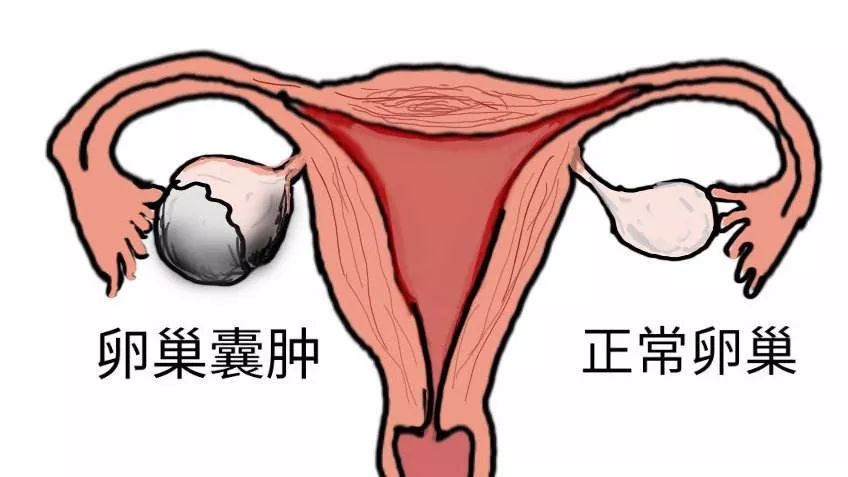 超声引导囊肿治疗费用,超声引导下的囊肿微创介入治疗