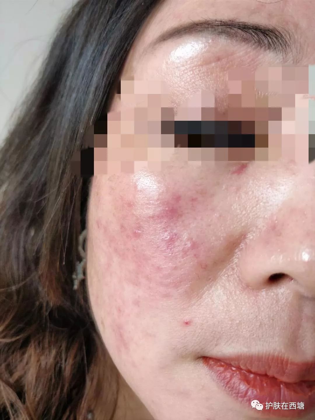 面部敏感性皮炎科普知识,激素依赖性皮炎是什么皮肤病