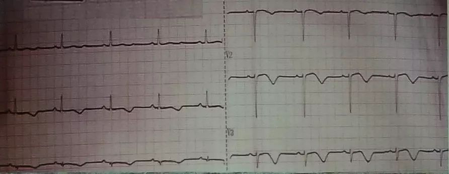 吴永全：如何运用体表心电图预测心室性猝死风险？｜OCC2019