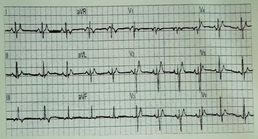吴永全：如何运用体表心电图预测心室性猝死风险？｜OCC2019
