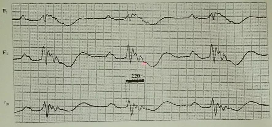 吴永全：如何运用体表心电图预测心室性猝死风险？｜OCC2019