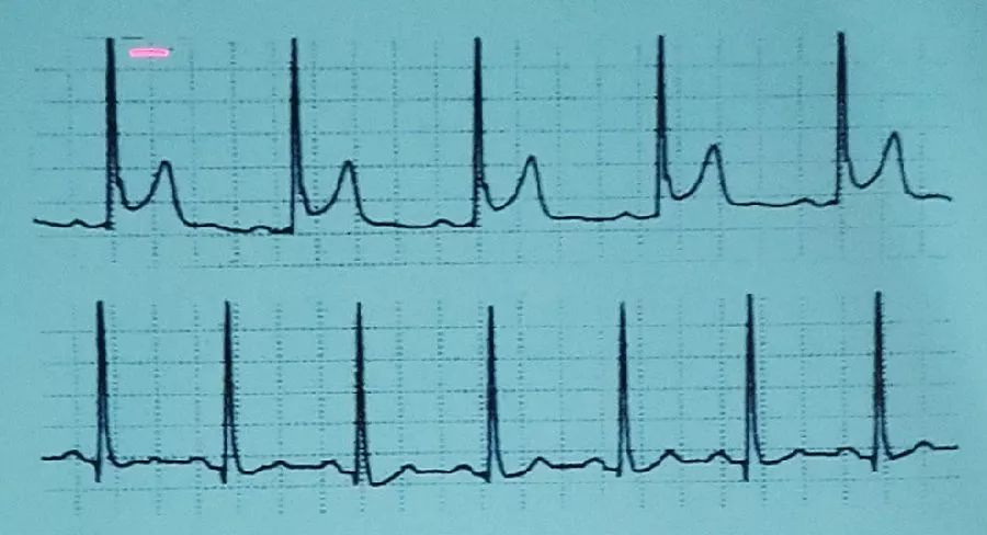 吴永全：如何运用体表心电图预测心室性猝死风险？｜OCC2019