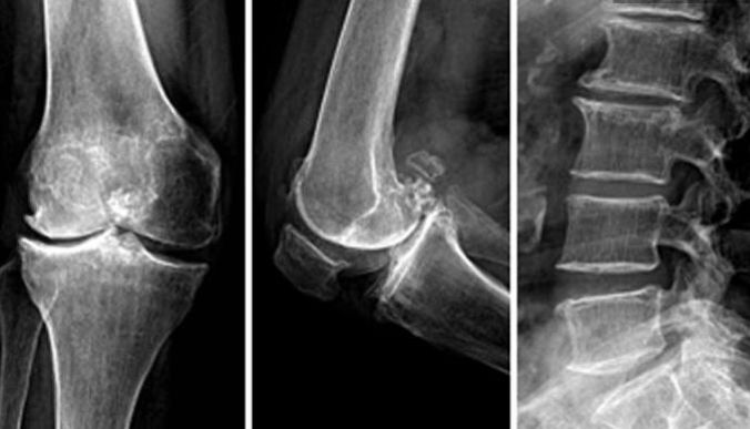 骨关节炎康复训练,骨关节炎的康复治疗专家共识