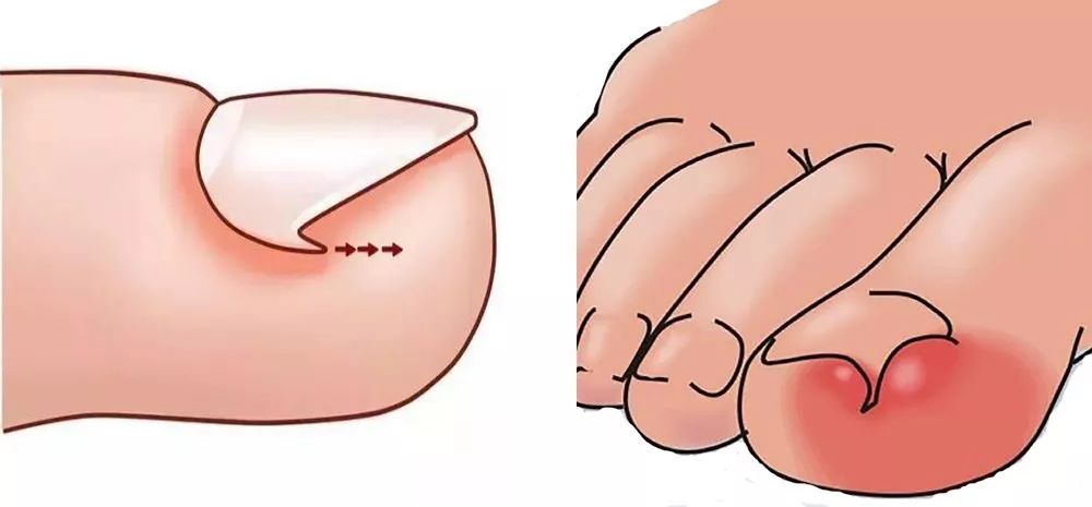 外科医生甲沟炎,甲沟炎医生推荐