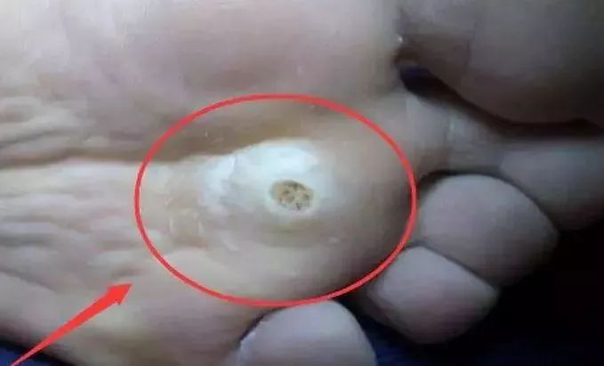 嫩脚神器告别死皮,脚死皮神器第一名