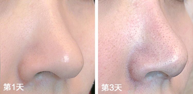 如何摆脱黑头反复的困扰才最有效,用黑头仪吸完黑头黑头还会再长吗