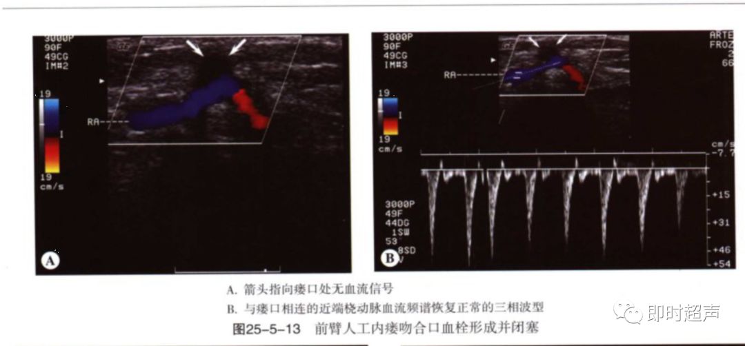 血液透析动静脉造瘘的超声评价