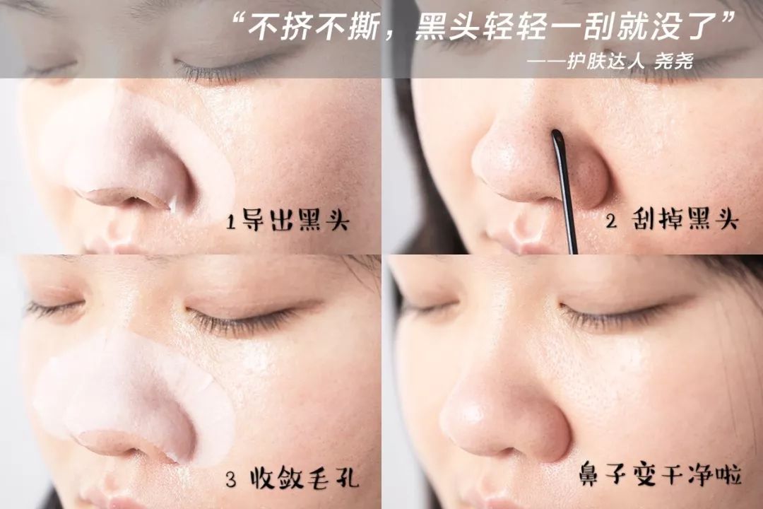 如何摆脱黑头反复的困扰才最有效,用黑头仪吸完黑头黑头还会再长吗