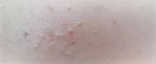 果酸适用何种痘,红痘印果酸