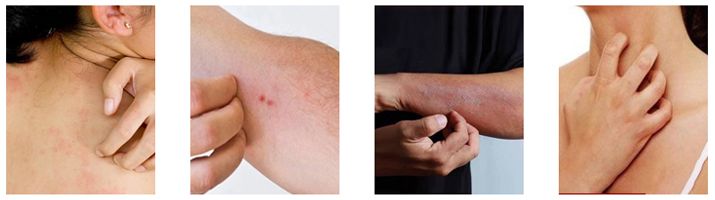 足癣药膏一天涂几次较好,湿疹性皮炎涂了一次药没效果