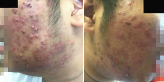 玉颜阁能祛痘痘吗,玉颜阁治什么病最好