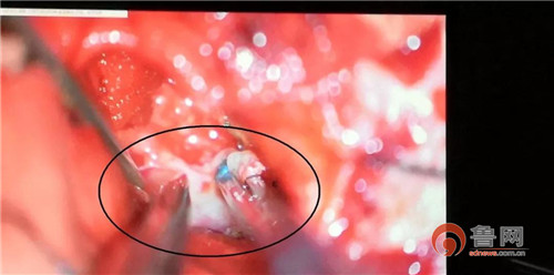 又一例技术突破！天坛医院专家带队，“锥尖”大耳道内切除“花生”大的肿瘤