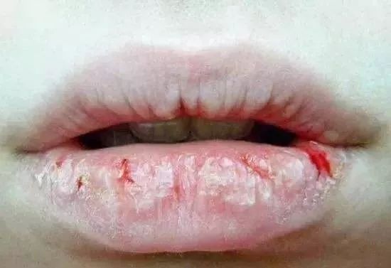 不要再撕嘴唇死皮了，很可能撕出这种病，会血流不止...
