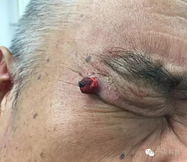 不要再撕嘴唇死皮了，很可能撕出这种病，会血流不止...