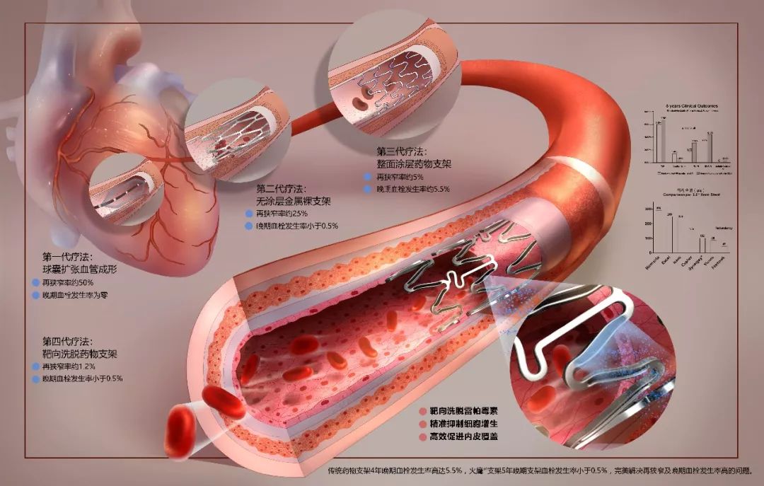 心室支架美国最新试验,美国最新心室支架