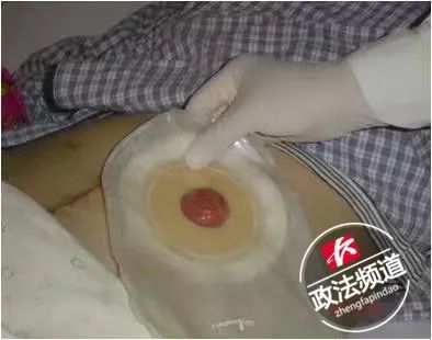 高压充气枪喷肛门？长沙小伙开玩笑差点要了同伴的命