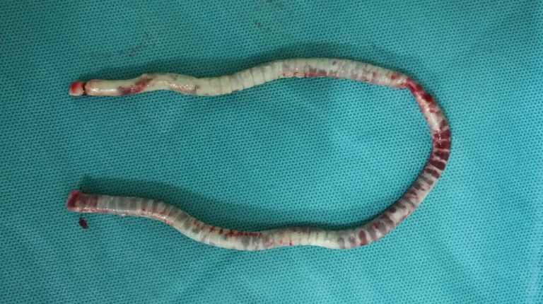 血透动静脉内瘘手术三种术式图解,血透室动静脉内瘘穿刺及护理