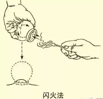 拔罐疗法你了解多少,根治型拔罐疗法书籍