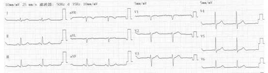 专栏丨贾卫滨：心电图“掉头”现象的鉴别诊断与发生机制（3）