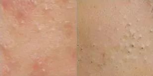 战痘总结,战痘十年是什么样子