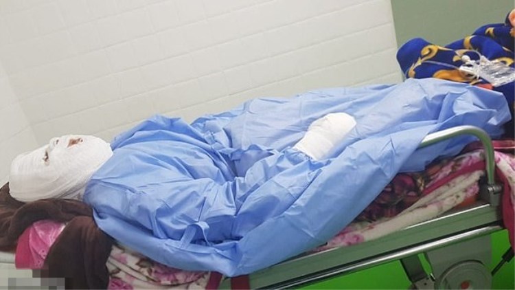 女子熟睡中惨遭毒手,熟睡烧伤女孩后续