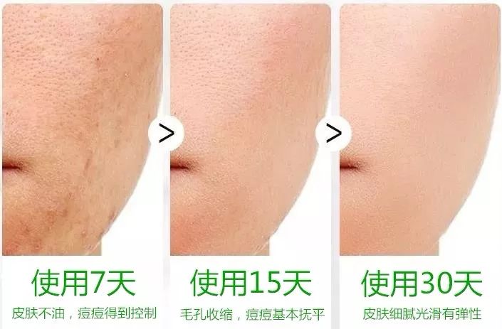 珊苏丽祛痘洁面皂,姗苏丽果酸洁面皂