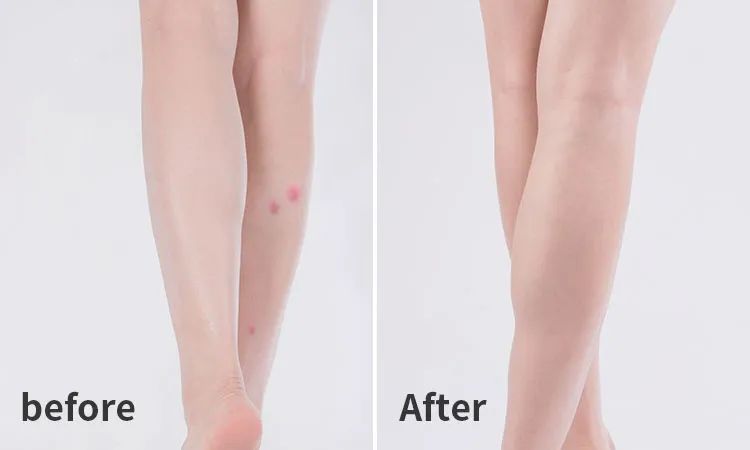 长小水泡很痒用什么中药,皮肤止痒起包用哪个药膏