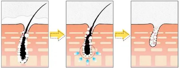 光滑无暇|黑丑的“毛裤腿”，用它，10分钟“脱”得一干二净，肌肤光滑细腻