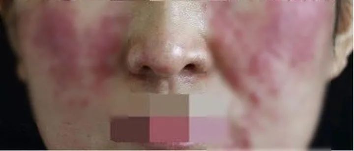 一紧张就脸红身上发红,一紧张就脸红