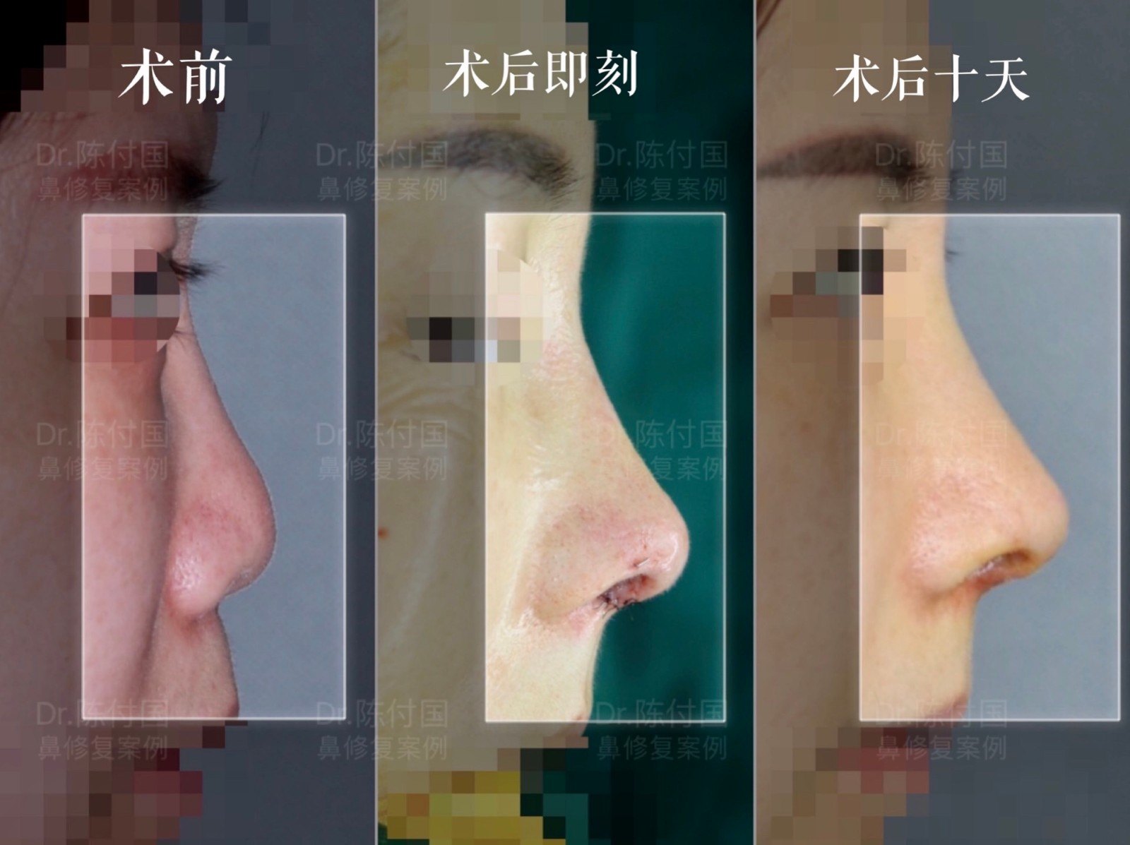 高难度扁鼻子修复,鼻综合手术疤痕修复