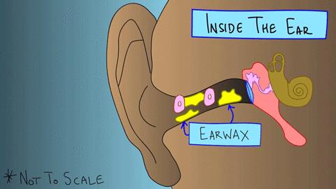 棉签抠耳朵导致癫痫,用棉签掏耳朵不小心被撞了一下