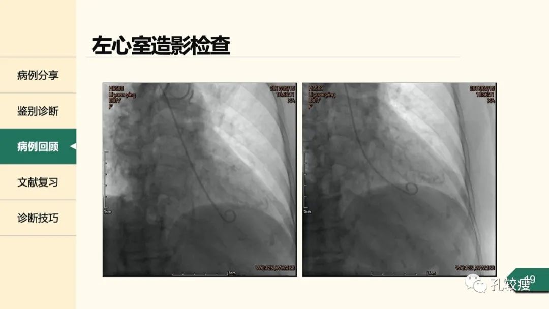 t波倒置在心电图中怎么看,T波低平心电图讲解