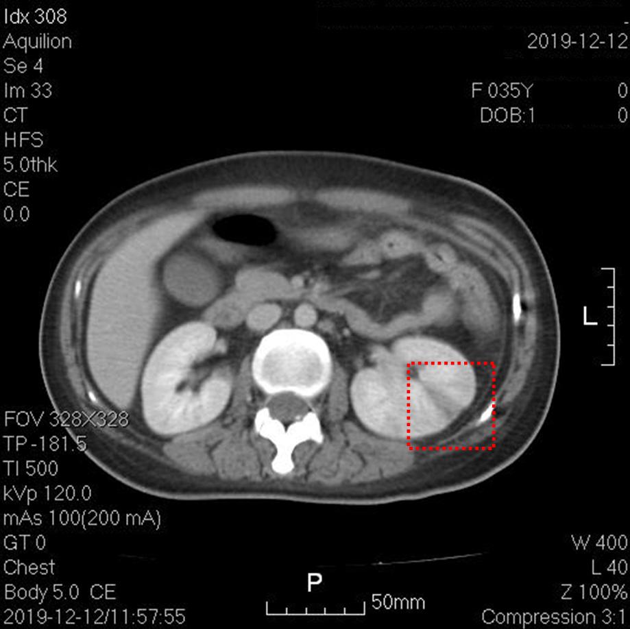 快看！心室“漏了个洞”，人竟然还活着……