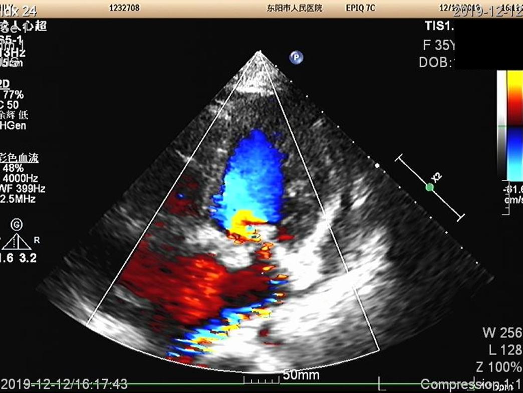 快看！心室“漏了个洞”，人竟然还活着……