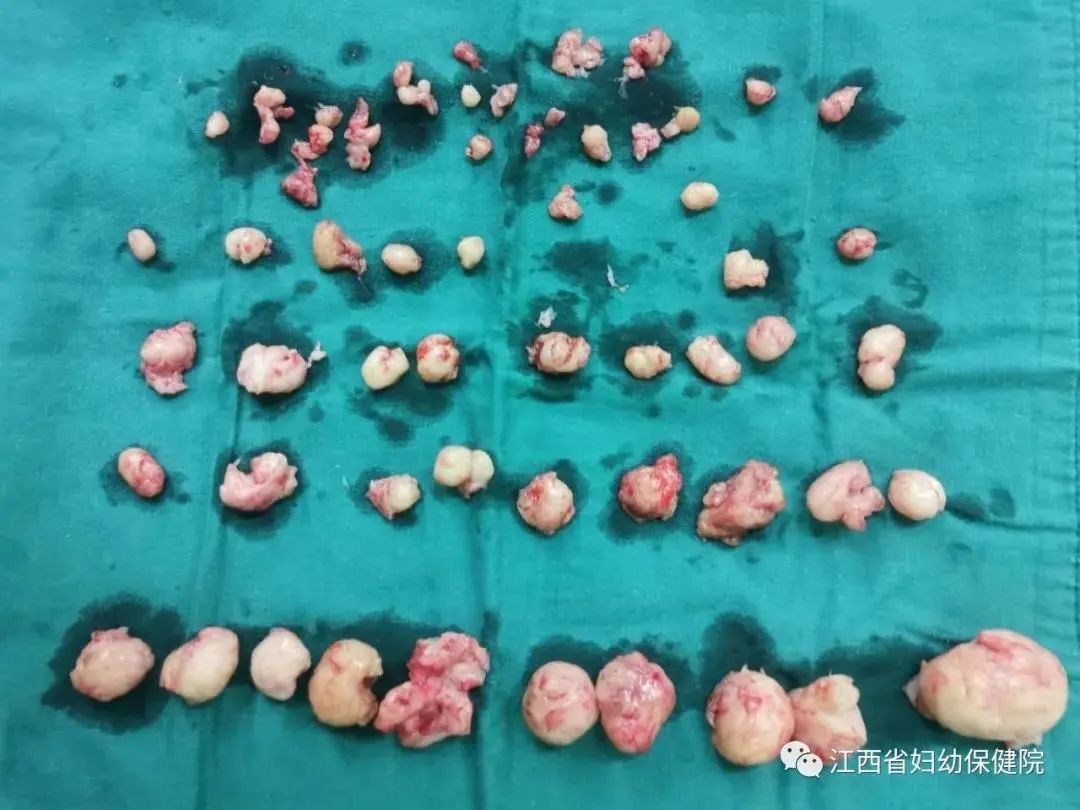 22岁女孩体内竟有上千颗肿瘤现状,女子腹中长肿瘤18cm