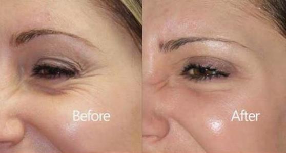 60岁没眼袋方法,教你一招去眼纹