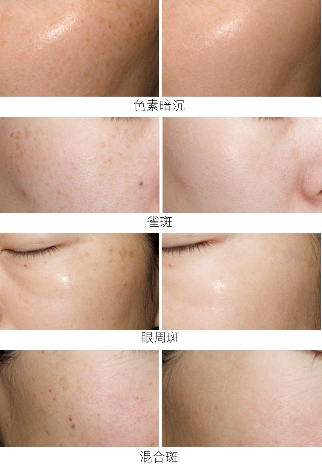 去斑点最有效方法医美去除斑痕,脸上暗沉有斑点可以做什么医美